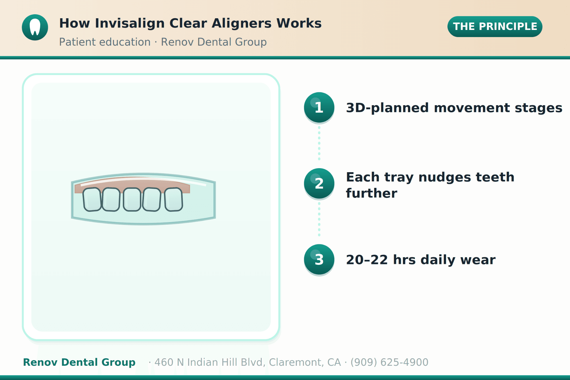 Invisalign Clear Aligners in La Verne