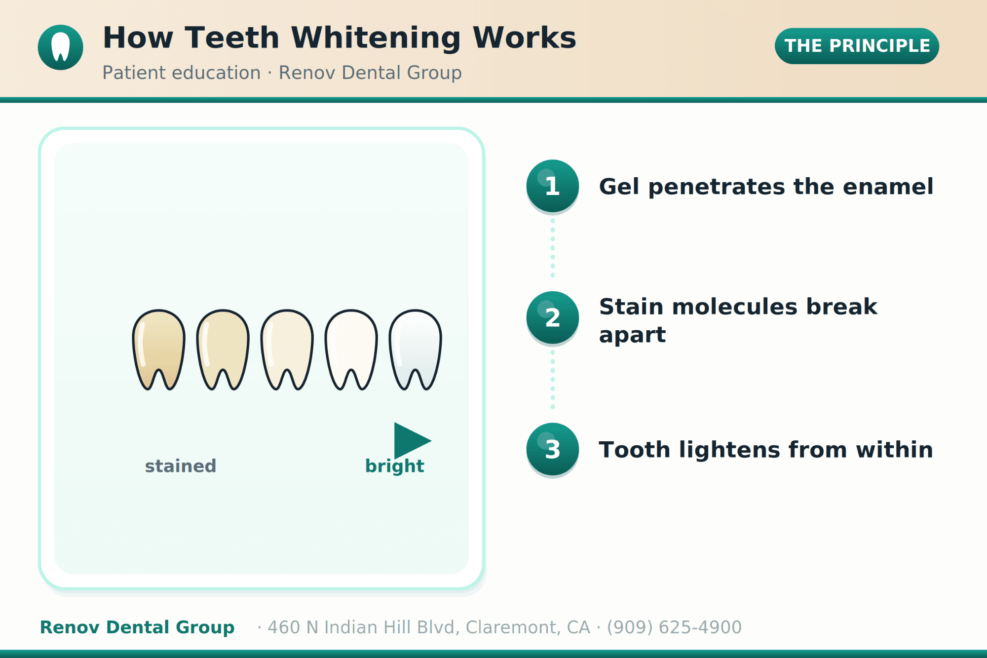 Teeth Whitening in Claremont