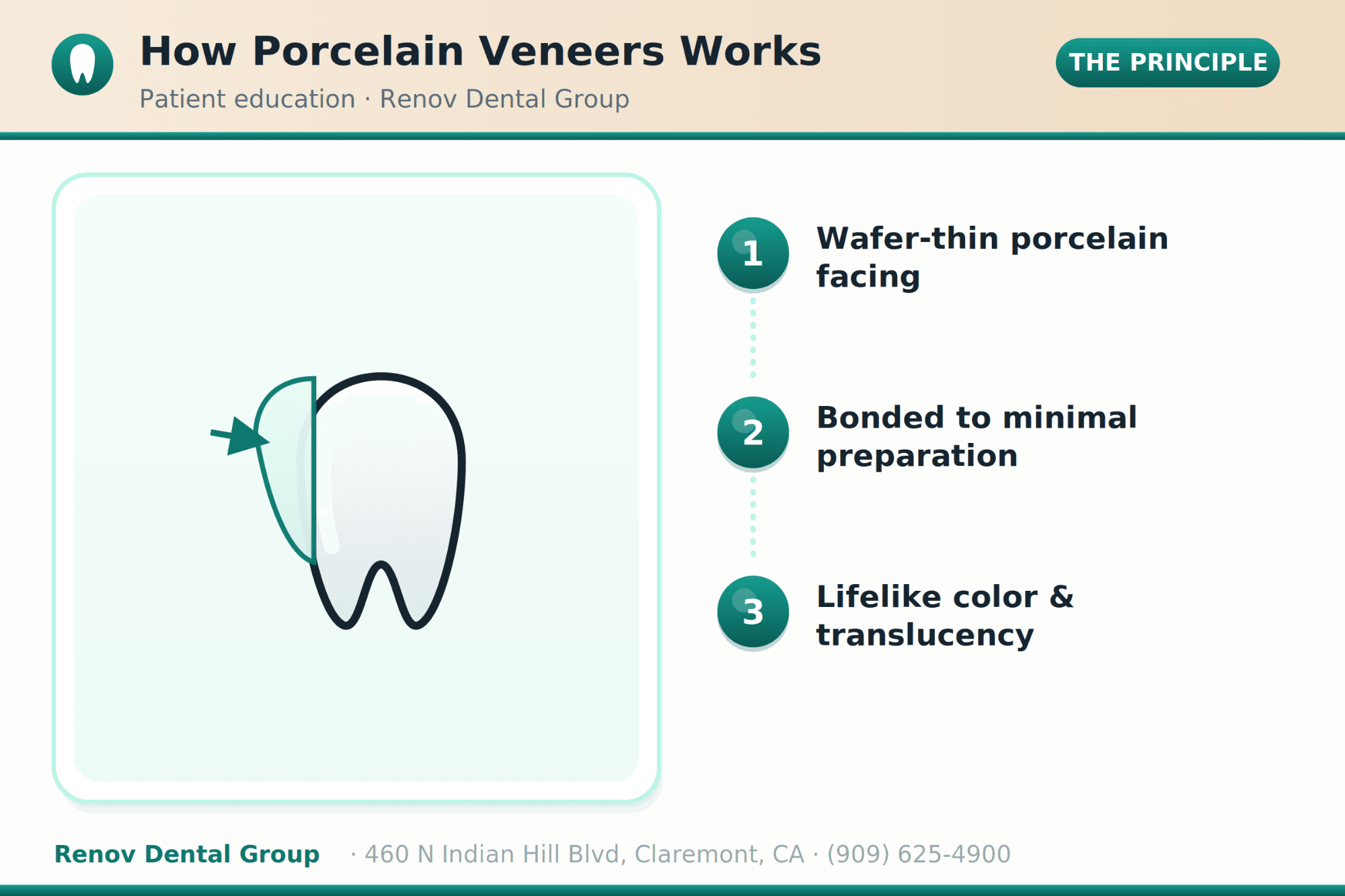 Porcelain Veneers in Claremont